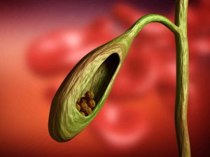 Safra Kesesi Taşını Mide Ağrısı İle Karıştırmayın