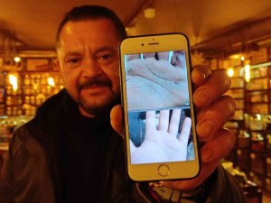 Yaptığı Bitkisel Karışımla Sedef Hastalığına Çare Buldu