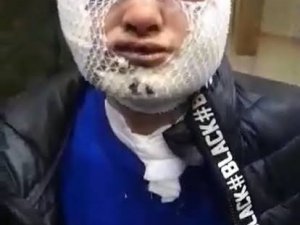 Kız Arkadaşının Yüzüne Kızgın Yağ Döken Zanlıya Yeniden Yakalama Kararı