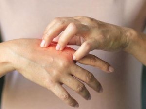 Soğuk Yanıklarına Dikkat; Kaşınma, Morarma Ve Ağrı Olabilir