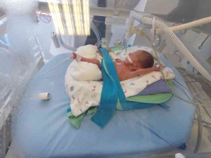 495 Gramlık Prematüre Bebeğe Kök Hücre Nakli Yapıldı