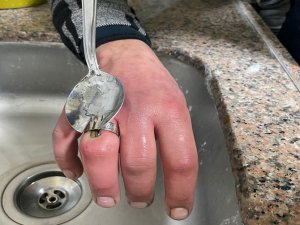 Trabzon'da parmağına sıkışan yüzüğü çıkaramayan kişiye itfaiye yardım etti