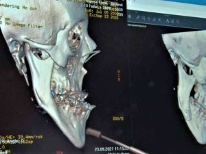 Doğuştan Çene Bozukluğu Olan Hastaya Estetik Çene: 21 Yıl Sonra Çenesi Düzeldi