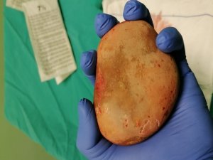 Mesaneden Çıkan Taş Doktorları Şaşırttı