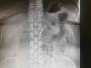Karın Ağrısı Şikayetiyle Gitti, 2 Tane Neşter Yuttuğunu Öğrendi