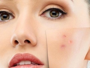 Hassas Ve Alerjik Ciltlere Mevsim Geçişlerinde Dikkat