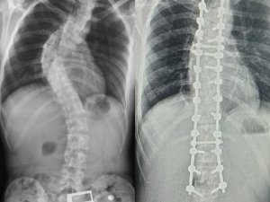 Tokat’tan Gelen Skolyoz Hastası Samsun’da Şifa Buldu