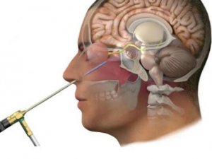 Yalova’da İ̇lk Kez Özel Atakent Hastanesi’nde Kapalı Yöntemle Endoskopik Hipofiz Cerrahisi Uygulandı