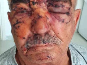 Beslediği Komşusunun Köpeğinin Saldırısına Uğradı