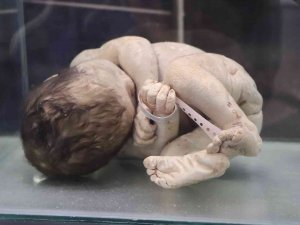 Asırlık Cerrahi Aletler Bu Müzede