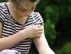 Yaz aylarında böcek ısırmalarına dikkat !