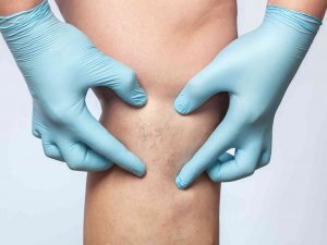 Thermoblock İle Kılcal Damarlarınızdan Anında Kurtulun