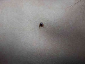 Çocuğun Sırtındaki Kene Hastanede Çıkartıldı