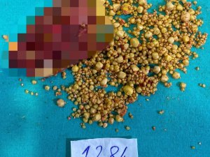 76 Yaşındaki Hastanın Safra Kesesinden Bin 284 Taş Çıktı