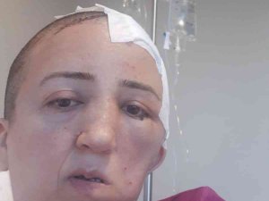 Kafatası Kemiği Kaybolmuştu, Ameliyatla Yenisi Takıldı