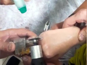 Parmağı Kangren Olmadan Kurtardılar