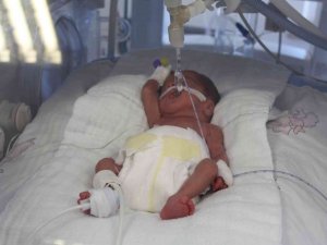 Tekirdağ’da 600 Gramlık Bebeğe Kök Hücre Nakli Yapıldı