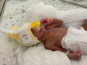 850 Gramlık Birsen Asel Bebek, 100 Günde Yaşama Tutundu