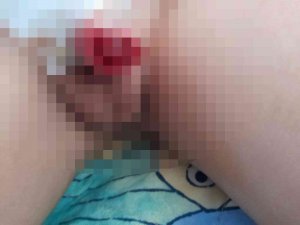 Yanlış Sünnet Edilen Çocuğun Hayatı Karardı: “21 Gündür Su İçmeye Korkuyor”