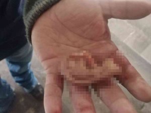Meksika’da Metroda Kavga Eden İki Kişiden Biri Diğerinin Kulağını Koparttı
