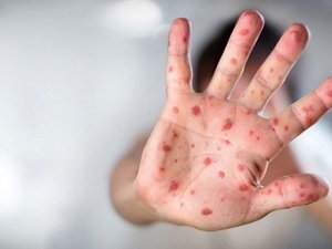 Çiçek Aşısı, Maymun Çiçeğine Karşı Yüzde 85 Koruyor