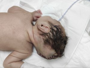 Beyninin Yarısı Kafatası Dışında Dünyaya Geldi