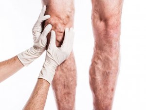 Venaseal Yöntemi İle Varislerinizden Ameliyatsız Kurtulun