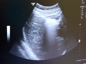 4 Boyutlu Ultrason İle Bebeğin Hastalıkları Doğmadan Anlaşılıp Tedavi Edilebiliyor