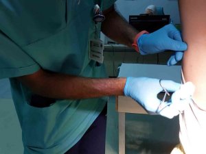 Samsun’da 8 Yaşındaki Çocuğa Tutunan Kene Hastanede Çıkarıldı