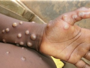 Uzmanı Uyardı: Maymun Çiçeği Vakalarında Artış Bekleniyor