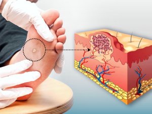 Siğiller Kâbusunuz Olmasın