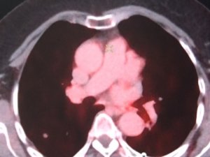 Diyarbakır’da Kanser Hastaları Son Nükleer Tıp Teknolojileriyle Şifa Buluyor