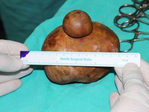 Karaman’da Bir Hastanın Mesanesinden 15x10 Ve 4x3 Büyüklüğünde 2 Taş Çıktı