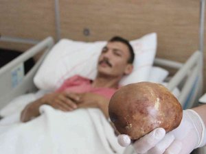 Hastaneye Başvuran Hastanın Mesanesinden 1 Kilo Taş Çıktı