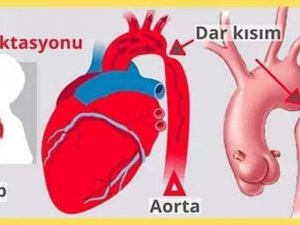 Bandırma’da İlk Kez Aort Koarktasyon Ameliyatı Yapıldı