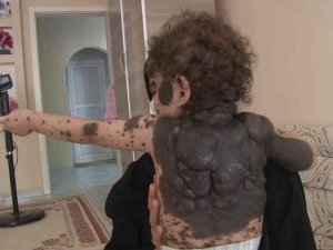 Vücudunda Kitlelerle Doğan Bebeğinin Tedavi Edilmesini İstiyor