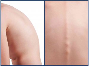 Ebeveynlerin Dikkati, Çocuklarda Görülen Skolyozun Önüne Geçiyor