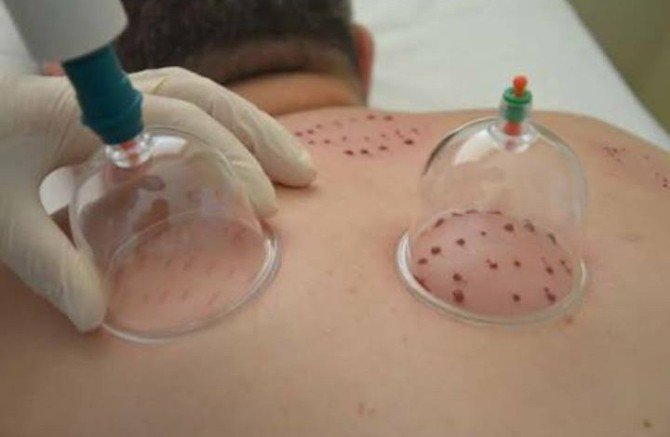 Hacamat Artık Hastanelerde Uygulanıyor