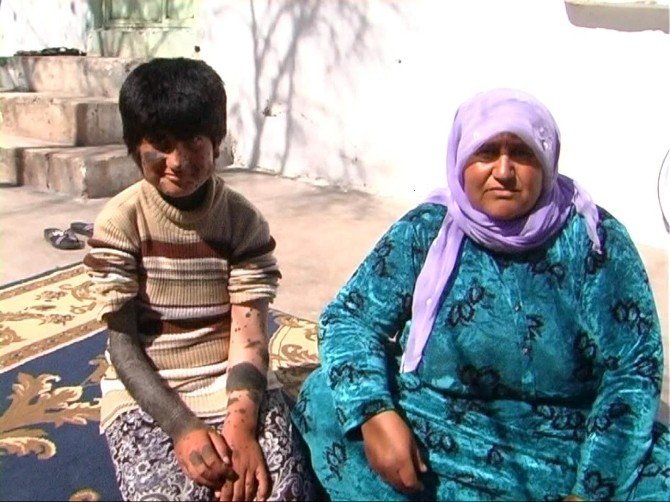 10 Yaşındaki Suriyeli Kızın Dramı Yürek Burkuyor