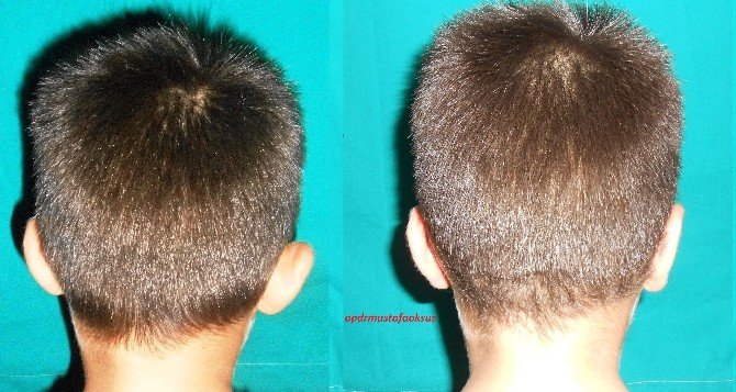 Kepçe Kulak Tarih Oluyor