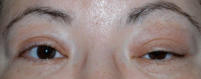 Göz Kapağı Düşüklüğü’ne Dikkat