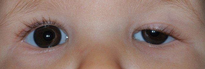 Göz Kapağı Düşüklüğü’ne Dikkat