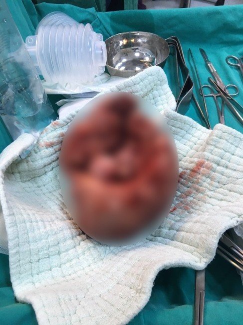 Rahminden 6,5 Kiloluk Kitle Çıkarıldı