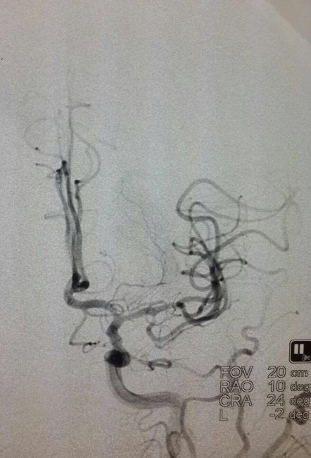 Her Altı Saniyede Bir Kişi İnme Geçiriyor