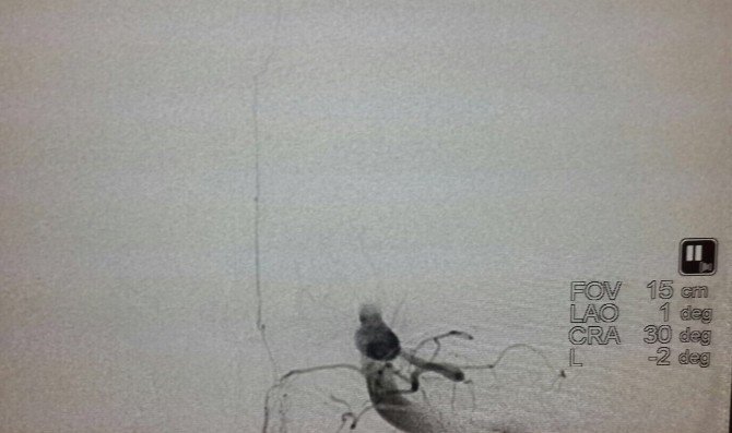 Her Altı Saniyede Bir Kişi İnme Geçiriyor