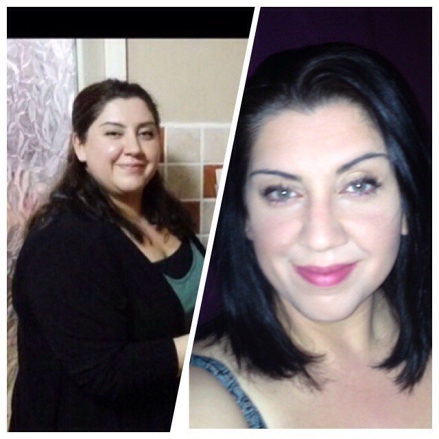 Obezitede Kalıcı Tedavinin Yöntemi Gastrikby-pass