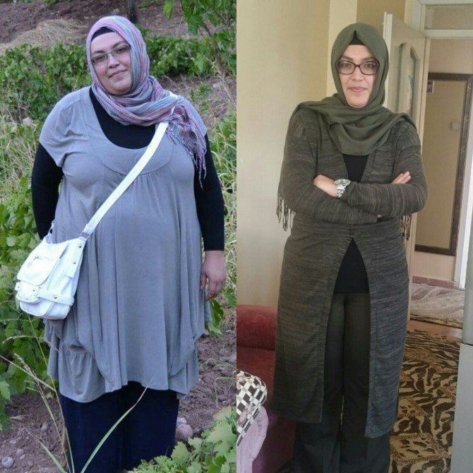 Tüp Mide Ameliyatı İle Hayatları Değişti