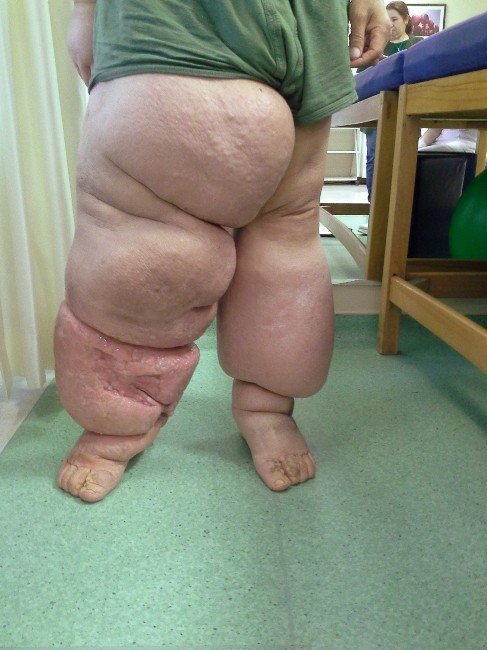 40 Yıl Sonra Fil Hastalığından Kurtuldu