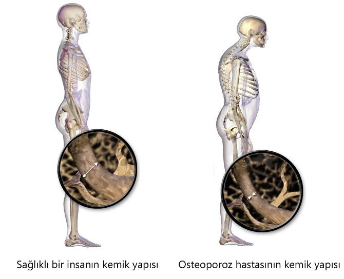 Beslenme Kemikleri Koruyor