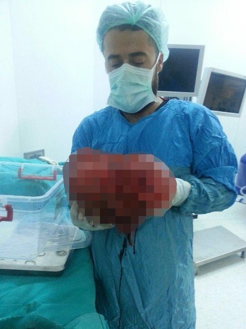 Bir Yılda 50 Kilo Veren Hastanın Karnından 20 Kiloluk Kitle Çıktı